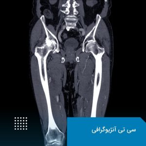 سی تی آنژیوگرافی