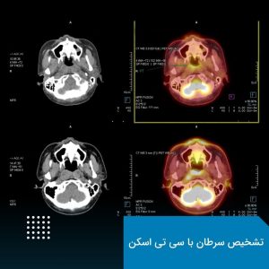 تشخیص سرطان با سی تی اسکن 3 تشخیص سرطان با سی تی اسکن
