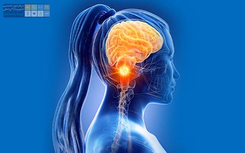 Mri مغز