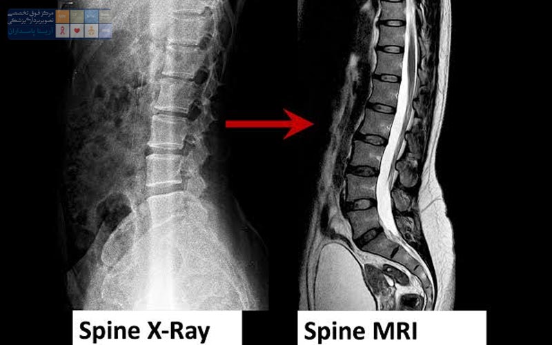 MRI ستون فقرات چیست 2 مراحل انجام MRI ستون فقرات