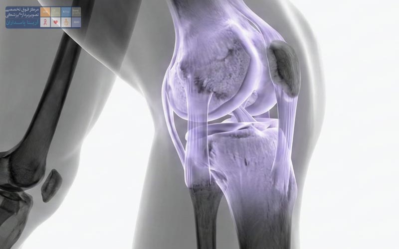 MRI زانو چیست 3 چه زمانی MRI زانو ضروری است؟