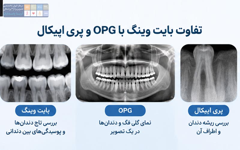 تفاوت بایت وینگ و OPG و پری اپیکال