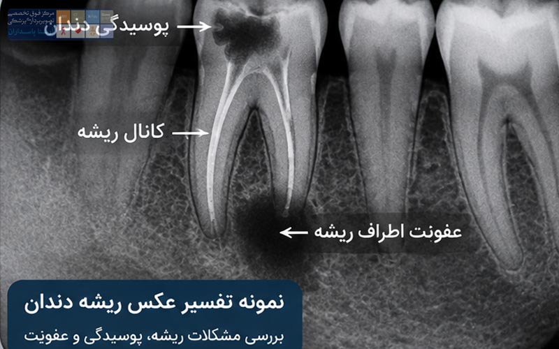 عکس ریشه دندان چیست؟ 3 تفسیر عکس پری اپیکال