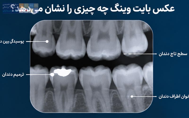 عکس بین دندانی چه چیزی را نشان می‌دهد؟