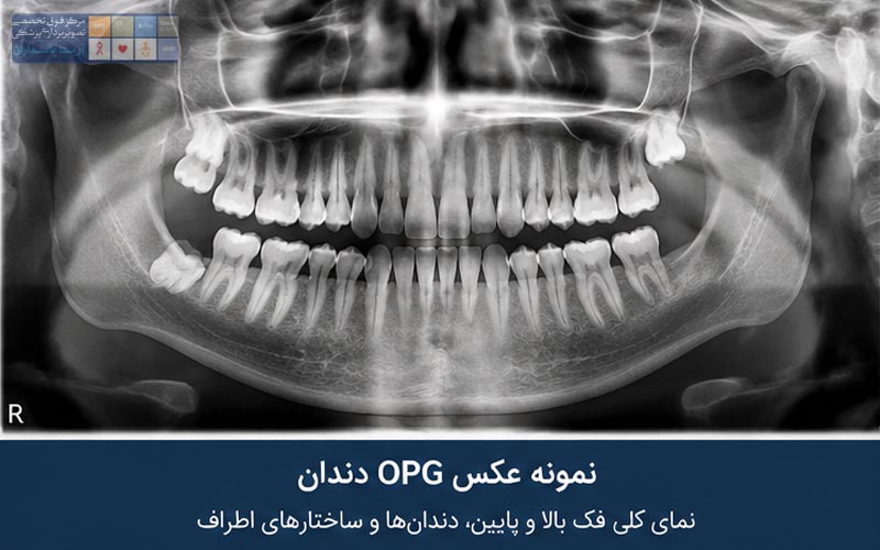 عکس OPG دندان چیست؟ 2 نمونه عکس OPG دندان