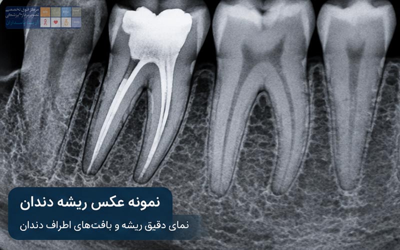 عکس ریشه دندان چیست؟ 2 نمونه عکس ریشه دندان